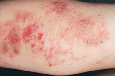 Treatment for Eczema and Dermatitis Treatment for Eczema and Dermatitis with L J Health Wellness Centre Nerang