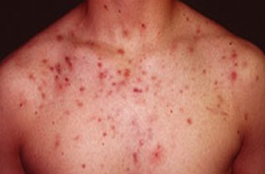 Your Guide to Managing Your Acne Your Guide to Managing Your Acne with L J Health
