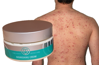 SKT (Skin Treatment) Oil and Cream – Powerful Natural Remedies For Acne, Dermatitis, Eczema & Psoriasis